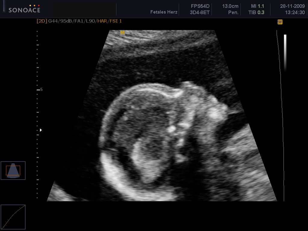 Ultraschall vom Embrio